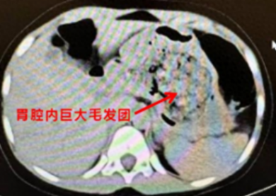 浙江一5岁女孩确诊长发公主综合征